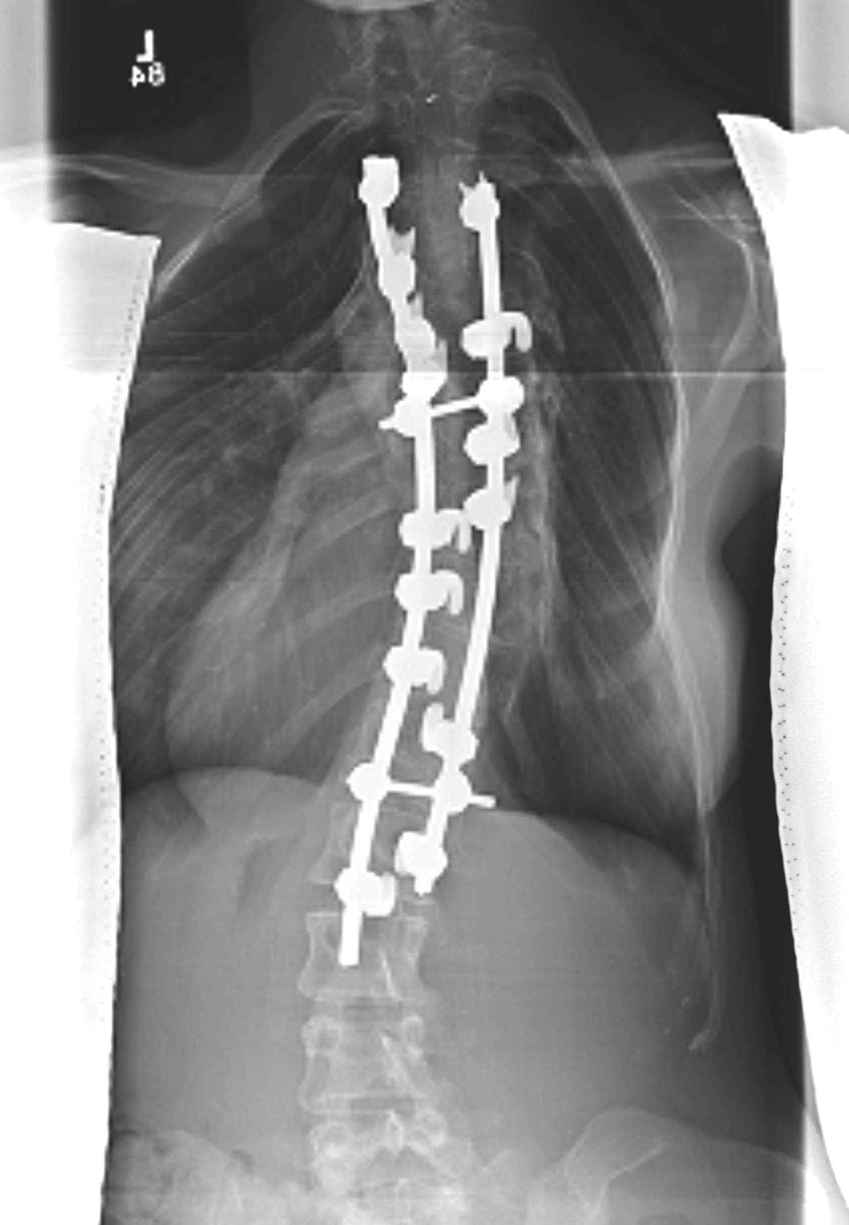 Scoliosis Fusion Double Thoracic